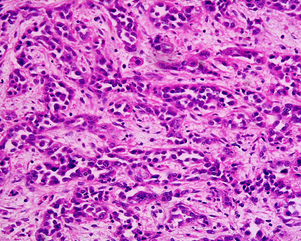Imagen: Microfotografía de un adenocarcinoma de estómago pobre a moderadamente diferenciado (Fotografía cortesía de Wikimedia Commons)