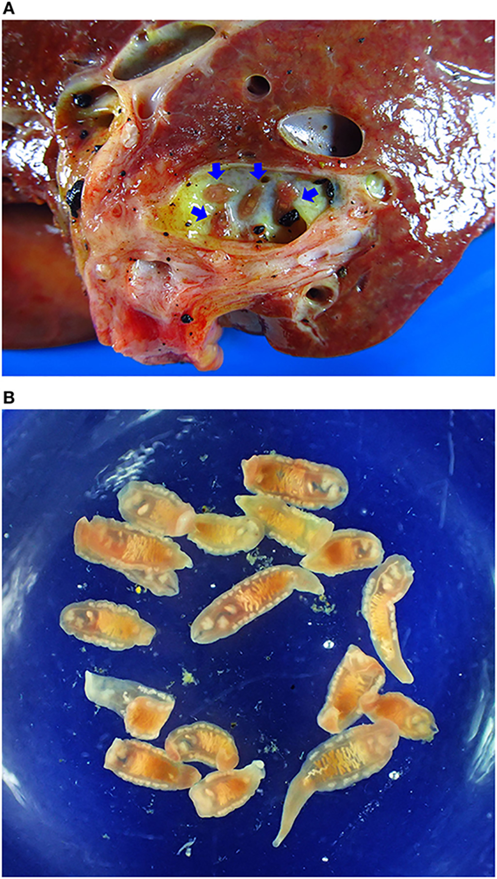 Imagen: Colangiocarcinoma asociado a opistorquiasis. (A) Muestra de colangiocarcinoma que muestra gusanos adultos en el conducto biliar (flechas azules). (B) Opisthorchis viverrini adulto recuperado del hígado (Fotografía cortesía de la Universidad de Khon Kaen)