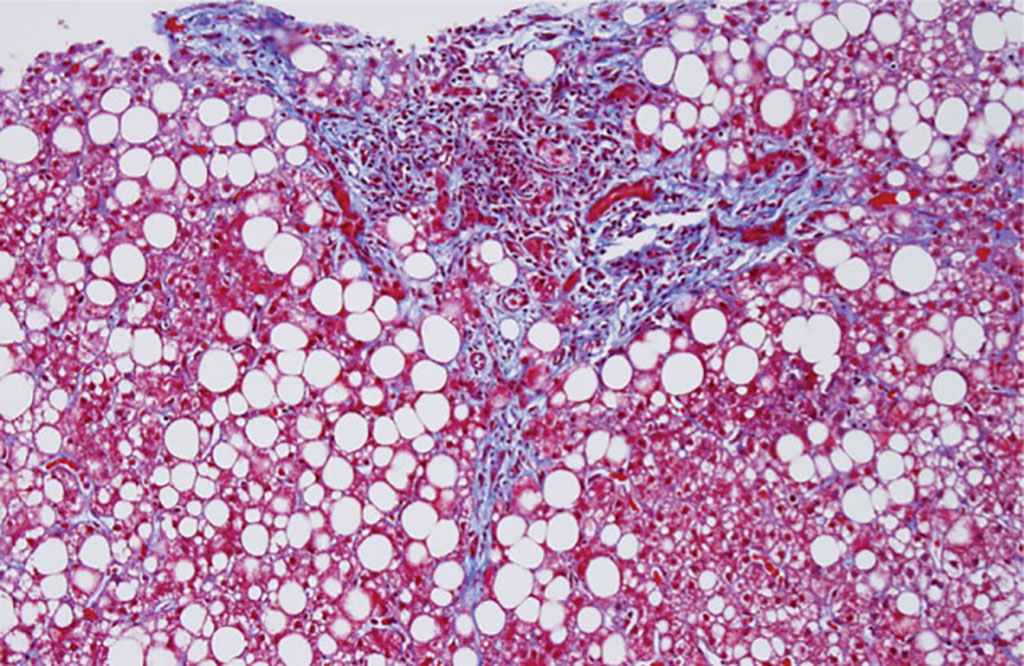 Imagen: Histopatología de la enfermedad del hígado graso no alcohólico pediátrico (NAFLD) Esta coloración tricrómica ilustra la esteatosis de la zona 1, la fibrosis portal y una reacción ductular, que caracterizan a la NAFLD pediátrica (Fotografía cortesía de Elizabeth M. Brunt MD)