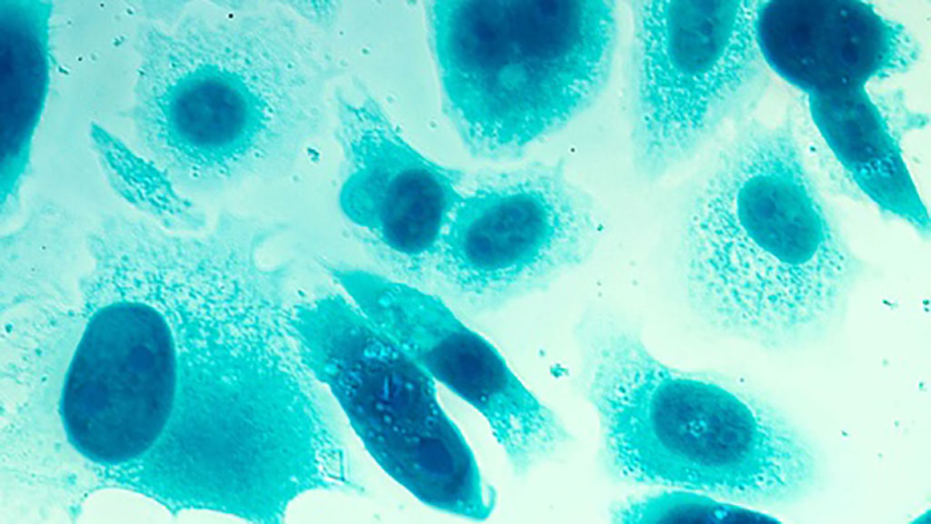Imagen: El nuevo ensayo de detección identifica los medicamentos dirigidos al cáncer de próstata (Fotografía cortesía de la Universidad de Aberdeen)