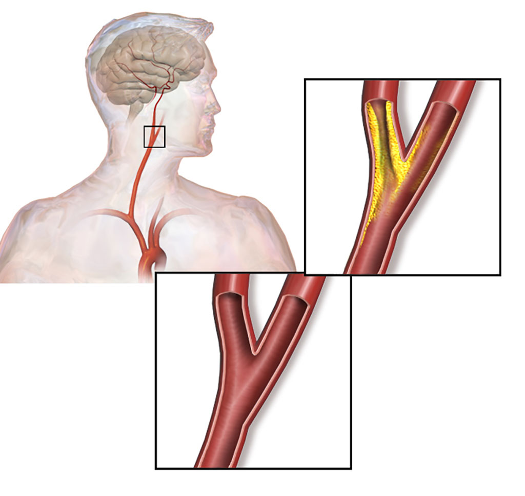 Imagen: Ilustración de aterosclerosis carotídea (Fotografía cortesía de Wikimedia Commons)