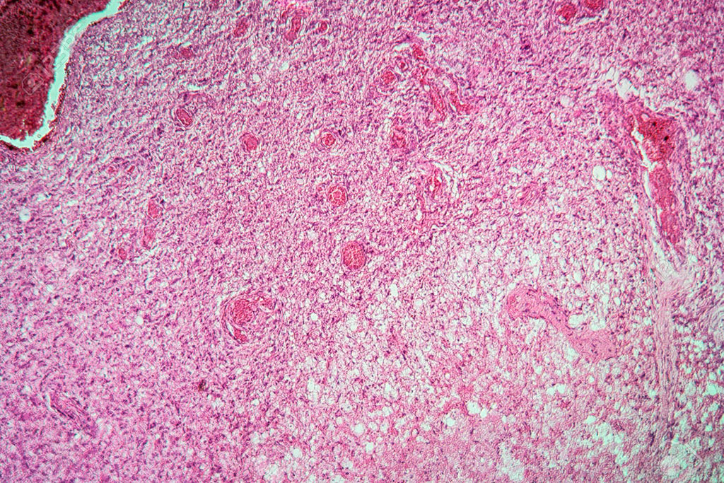 Imagen: Micrografía de tejido cerebral con agrandamiento de glioma e histología de la enfermedad (Fotografía cortesía de 123rf.com)