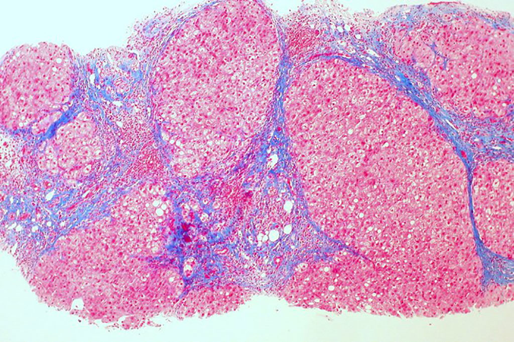 Imagen: Micrografía de una muestra de hígado con tinción de tricromo, que muestra la cirrosis como una textura nodular rodeada de fibrosis (el colágeno se tiñó de color azul) (Fotografía cortesía de Wikimedia Commons)