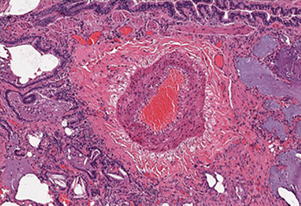 Imagen: Histopatología en la que se observa una arteriola pulmonar de un paciente con hipertensión arterial pulmonar asociada a esclerosis sistémica que muestra hipertrofia medial significativa (Fotografía cortesía de la Universidad de Colorado)