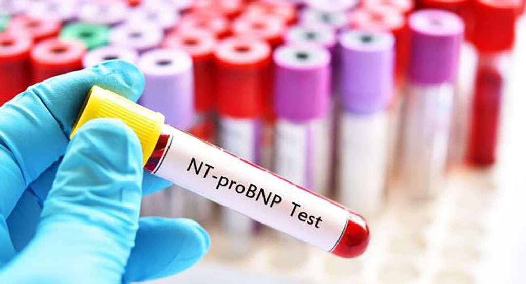 Imagen: La concentración de péptidos natriuréticos de tipo B pro-N-terminal (NT-proBNP) podría significar riesgos absolutos drásticamente diferentes de insuficiencia cardíaca (IC) para diferentes grupos demográficos (Fotografía cortesía de TCTMD)