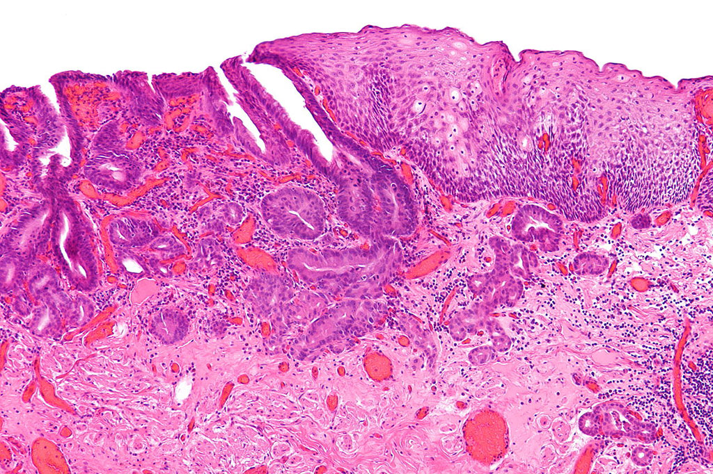 Imagen: Fotomicrografía que muestra el aspecto histopatológico de un adenocarcinoma esofágico (azul oscuro, parte superior izquierda de la imagen) y epitelio escamoso normal (parte superior derecha de la imagen) (Fotografía cortesía de Nephron)