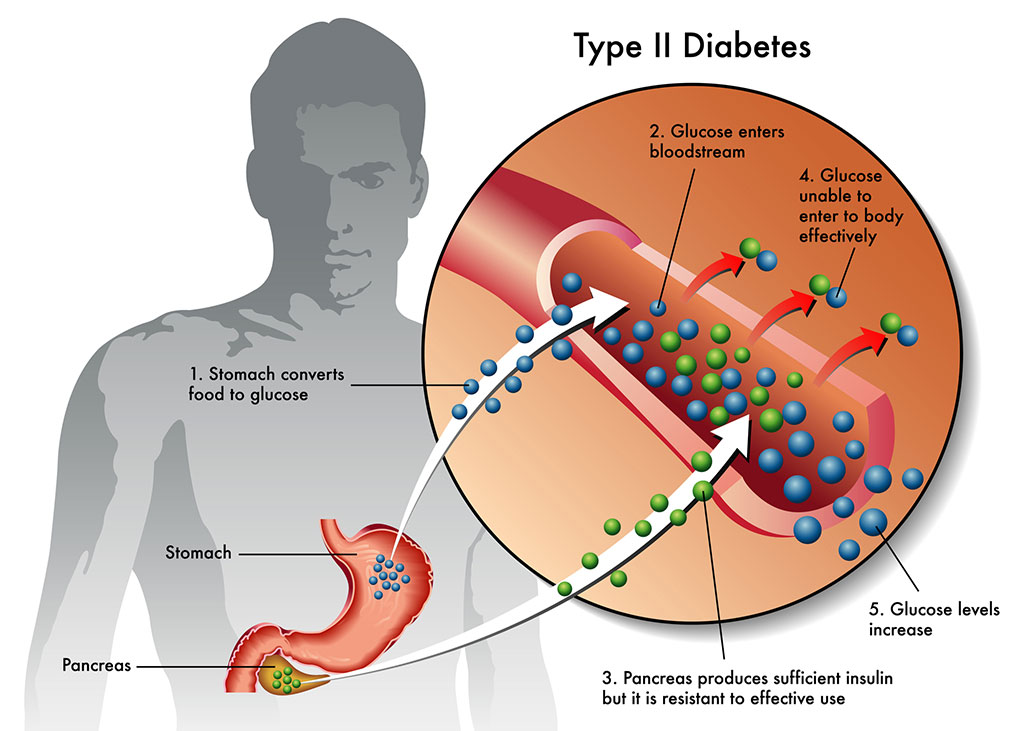 Imagen: Diabetes tipo II (Fotografía cortesía de 123rf.com)