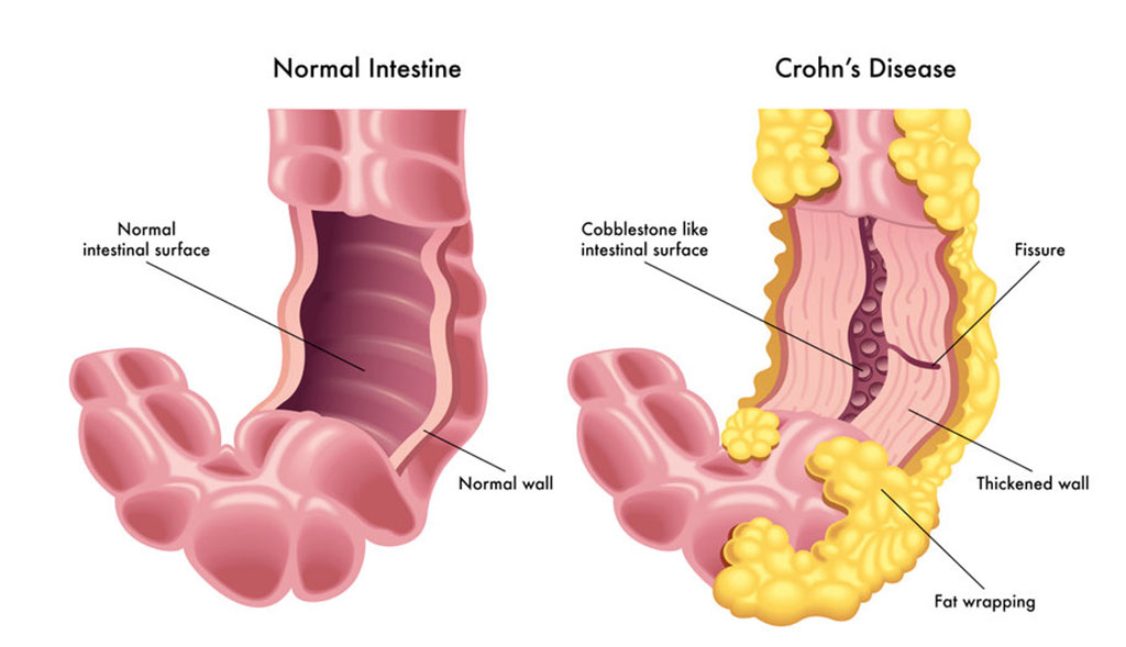 Imagen: Ilustración de una sección de un intestino normal comparado con una sección de intestino afectado por la enfermedad de Crohn (Fotografía cortesía de 123rf.com)