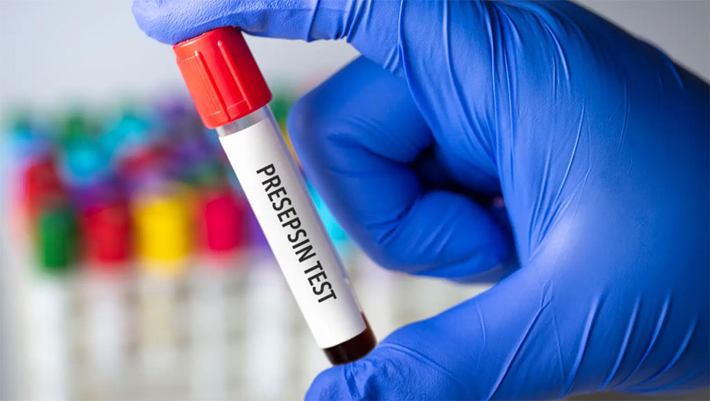Imagen: La presepsina se ha propuesto como un biomarcador “robusto” de la sepsis de aparición temprana (Fotografía cortesía de Ian Ingram, BA)