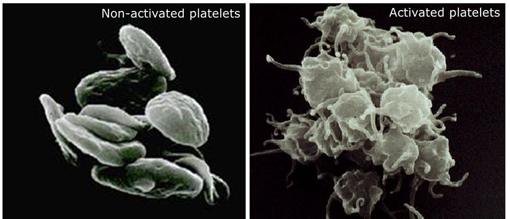 Imagen: Micrografías electrónicas de barrido de plaquetas no activadas y activadas (Fotografía cortesía de los Servicios Canadienses de Hematología)
