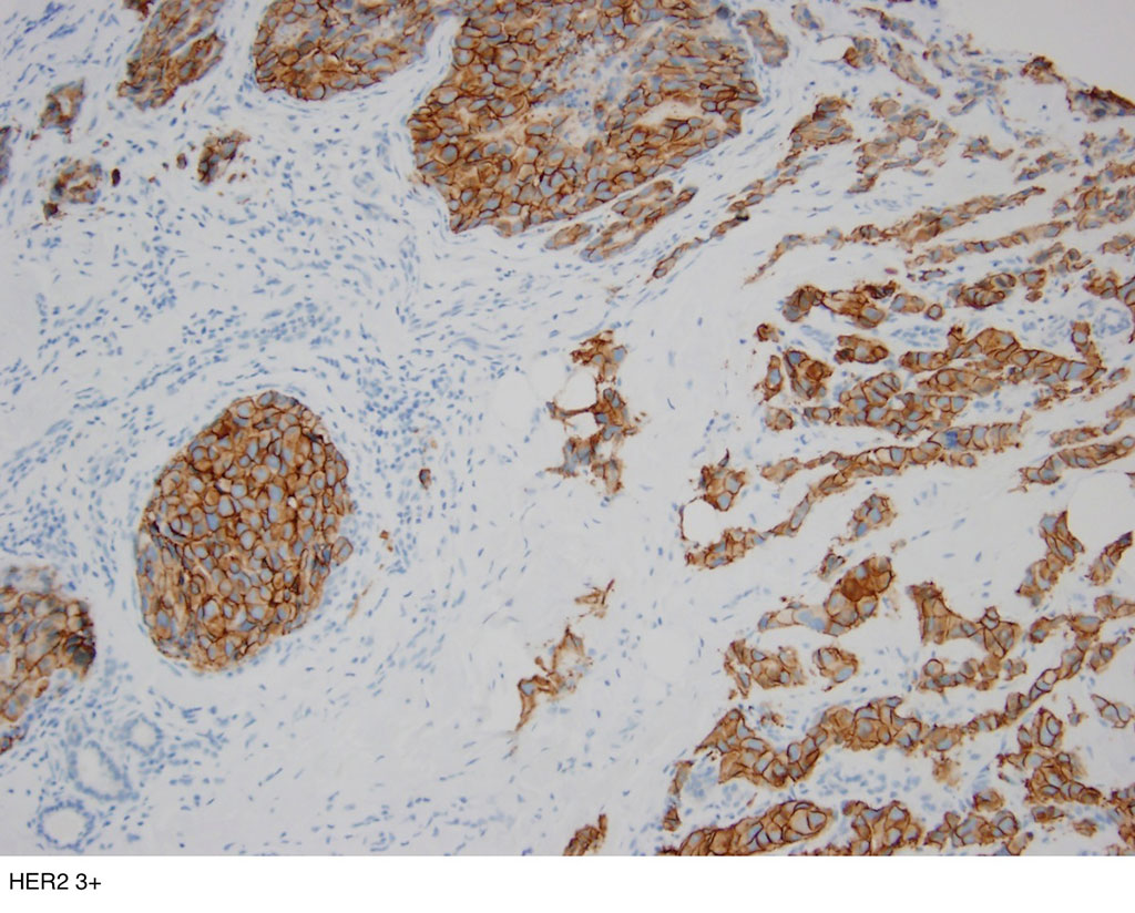 Imagen: Histopatología del cáncer de mama con receptores hormonales positivos para (HR+) (Fotografía cortesía de Emily S. Reisenbichler, MD)