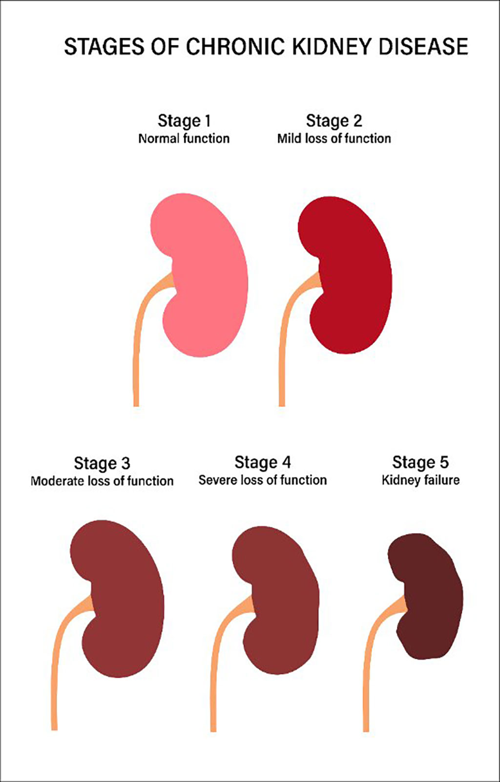Imagen: Representación visual del concepto de enfermedad renal (Fotografía cortesía de 123rf.com)