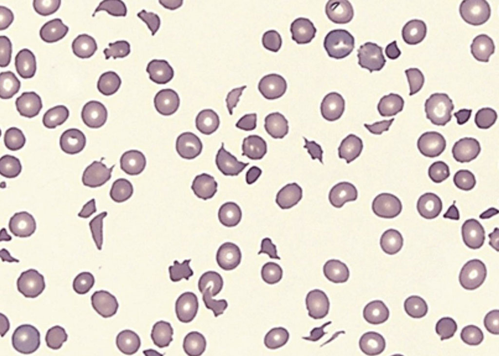 Imagen: Frotis de sangre periférica de un paciente con púrpura trombocitopénica trombótica que muestra anemia hemolítica microangiopática con numerosos esquistocitos y trombocitopenia (Fotografía cortesía de la Clínica Cleveland)