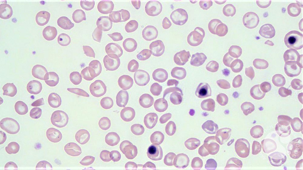 Imagen: Frotis de sangre de un paciente con heterocigosis de células falciformes/compuesto de talasemia β 0, que muestra una célula falciforme, células en bote, células diana, tres glóbulos rojos nucleados, anisocitosis, poiquilocitosis (Ke Xu, MD)