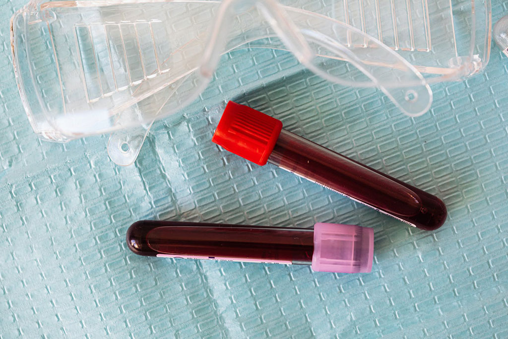 Imagen: Los investigadores tienen como objetivo transformar el tratamiento del cáncer con solo una cucharada de sangre (Fotografía cortesía de Pexels)