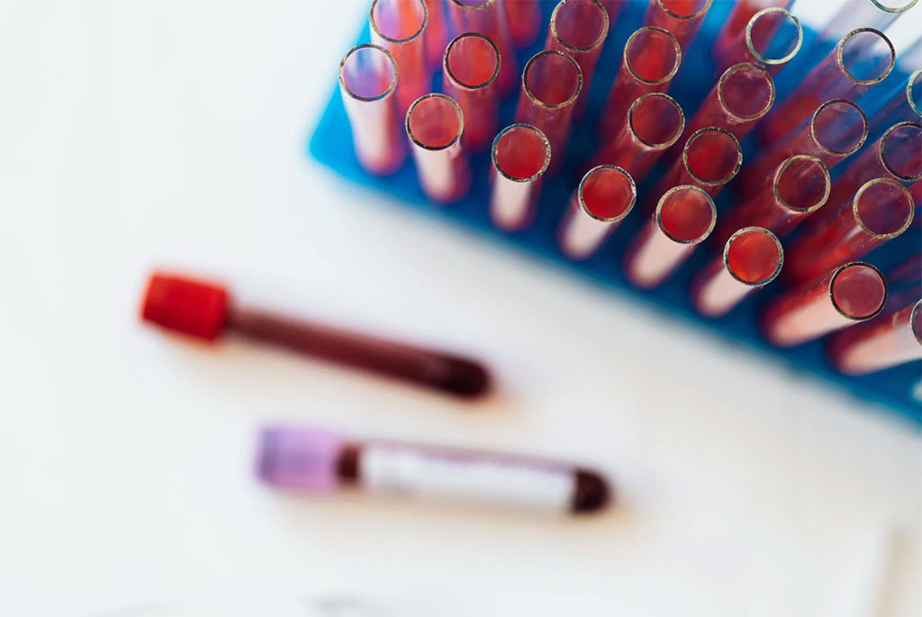 Imagen: Una nueva prueba proporciona un diagnóstico de cáncer de próstata rápido, sin complicaciones y específico a partir de muestras de sangre (Fotografía cortesía de Pexels)