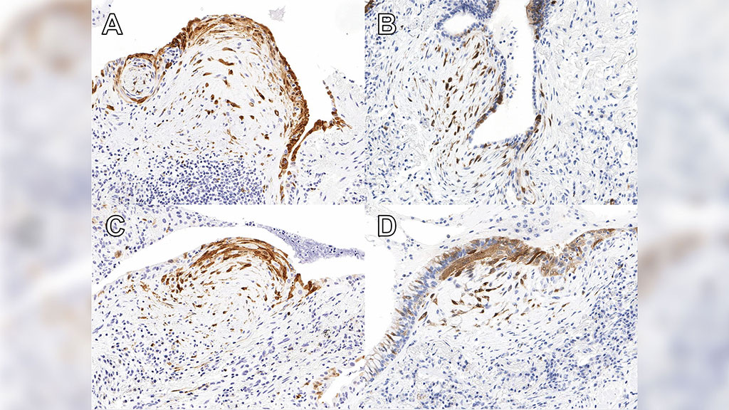 Imagen: Los focos positivos para P16 se definieron como una expresión concurrente de P16 (marrón) en colecciones sueltas de fibroblastos el plano suprayacente (A), simple cuboidal (B y C) o epitelio columnar (D) (Fotografía cortesía del Instituto de Investigación de Salud de Lawson)