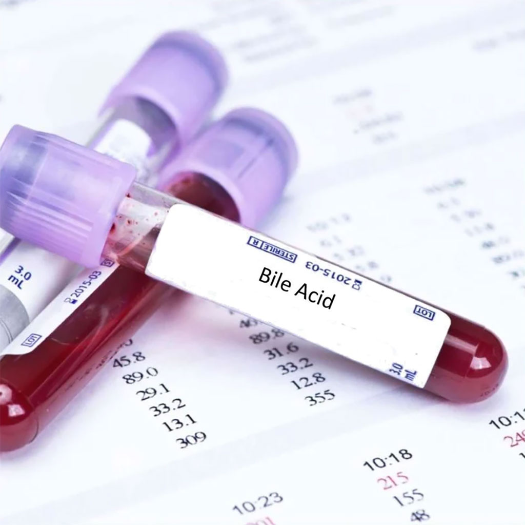 Imagen: El perfil de ácido biliar en suero alterado en la fibromialgia se asocia con cambios específicos en microbioma intestinal y gravedad de los síntomas (Fotografía cortesía de Análisis de Sangre en Londres)