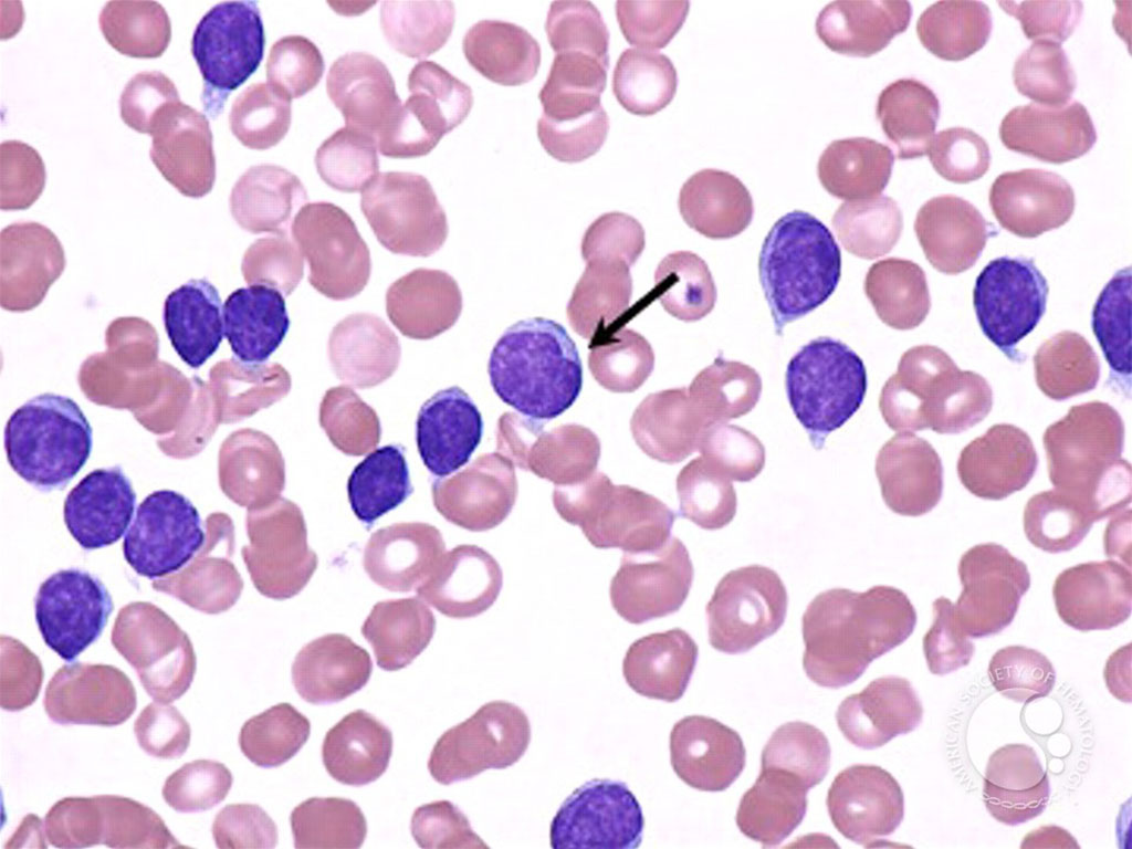 Imagen: Frotis de sangre de un paciente con leucemia linfoide crónica. Un linfocito grande (flecha) tiene un núcleo con muescas y demuestra la apariencia variable de algunos de los linfocitos en la LLC (Fotografía cortesía del profesor Peter G. Maslak, MD)
