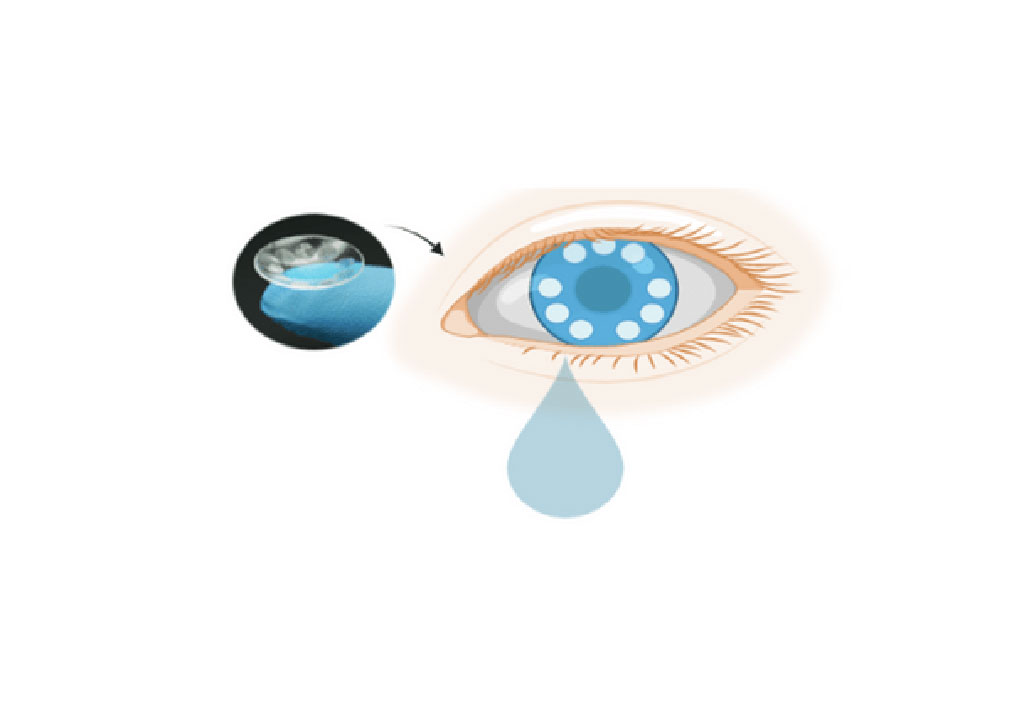 Imagen: Los investigadores han desarrollado un tipo novedoso de lente de contacto que puede capturar y analizar las lágrimas para la detección de exosomas, que tienen el potencial de ser biomarcadores de diagnóstico de cáncer (Fotografía cortesía del Instituto Terasaki para la Nnnovación Biomédica)