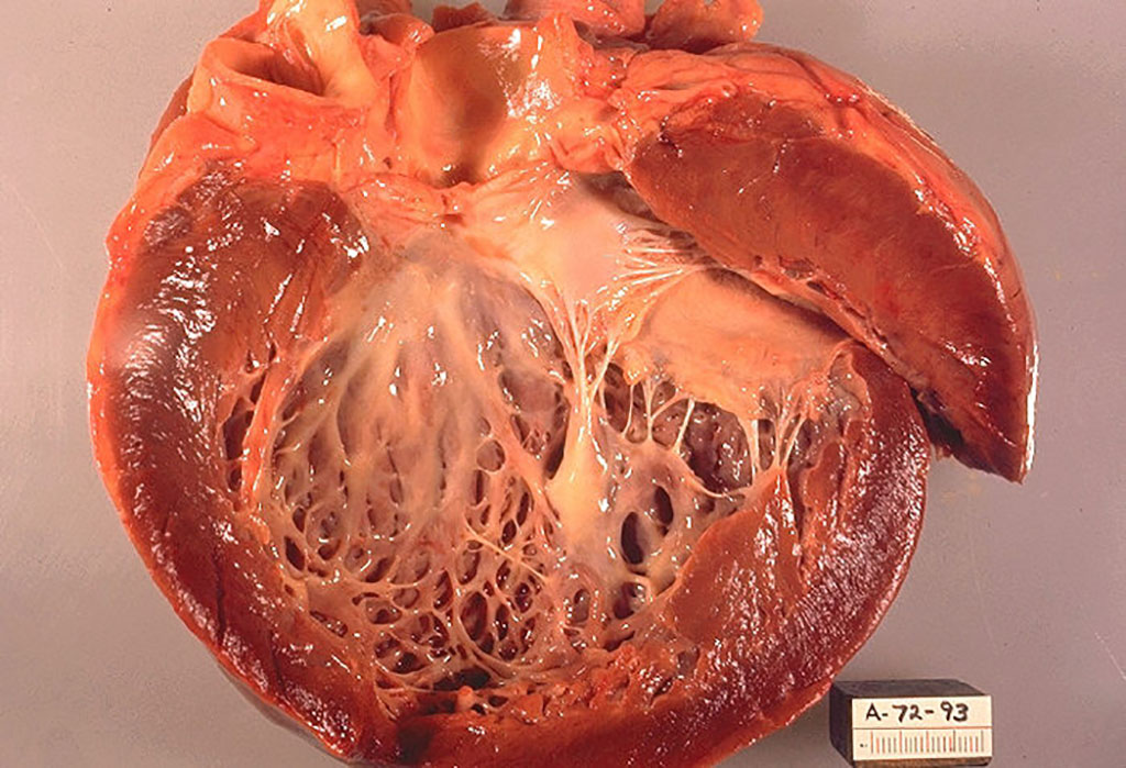 Imagen: Patología macroscópica de la miocardiopatía idiopática. El ventrículo izquierdo abierto del corazón muestra un ventrículo izquierdo engrosado y dilatado con fibrosis subendocárdica que se manifiesta como un aumento de la blancura del endocardio. (Fotografía cortesía del Dr. Edwin P. Ewing, Jr.)