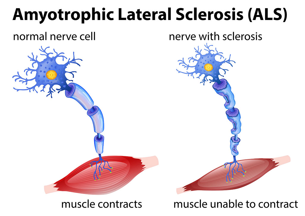 Imagen: Concepción de un artista de la esclerosis lateral amiotrófica (ELA) (Fotografía cortesía de www.123rf.com)