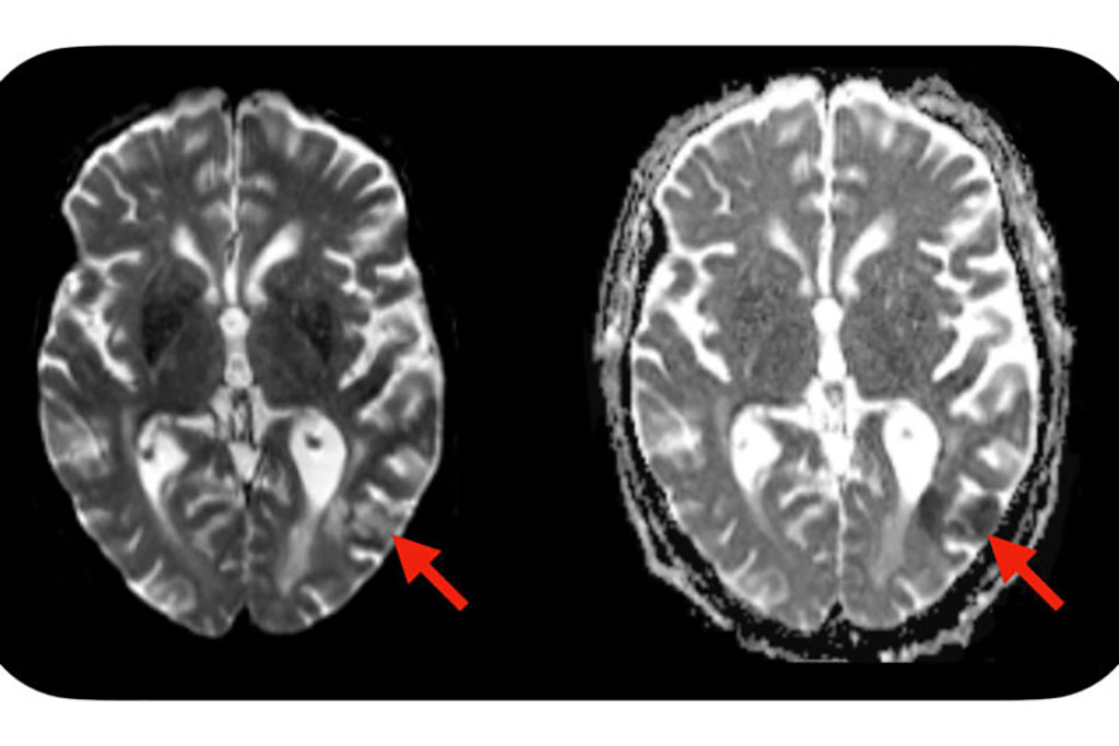 Imagen: Un simple análisis de sangre, administrado antes de iniciar el tratamiento con células CAR-T, puede identificar qué pacientes están predispuestos a desarrollar efectos secundarios neurotóxicos después de la terapia con células CAR-T. Los efectos secundarios graves pueden incluir convulsiones, inflamación del cerebro y accidentes cerebrovasculares. Se observa evidencia de un derrame cerebral (flechas rojas) en esta RM del cerebro de un paciente que desarrolló efectos secundarios neurotóxicos después de la terapia con células CAR-T (Fotografía cortesía del Dr. Omar Butt, Facultad de Medicina de la Universidad de Washington)