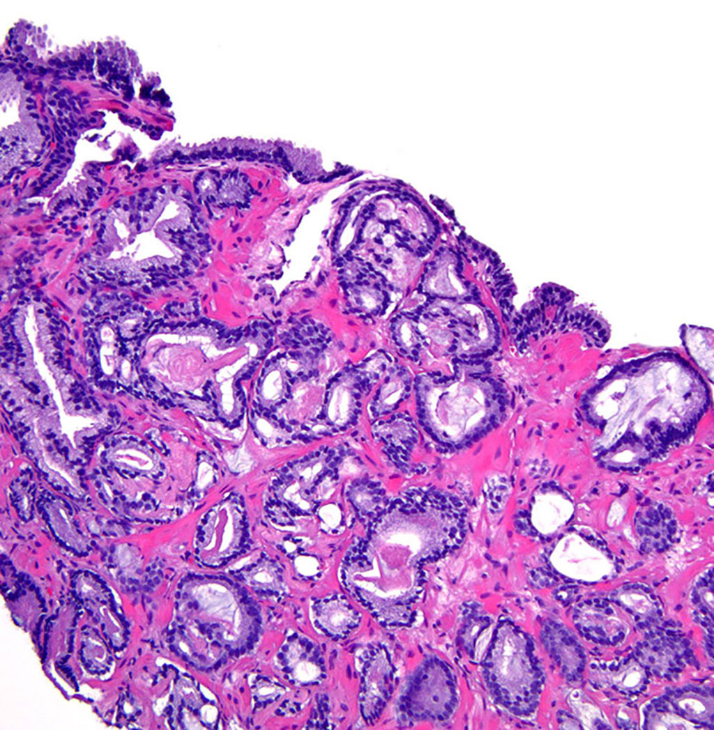 Imagen: Histopatología de la fibroplasia mucinosa en el cáncer de próstata (Fotografía cortesía de Clínica Cleveland)