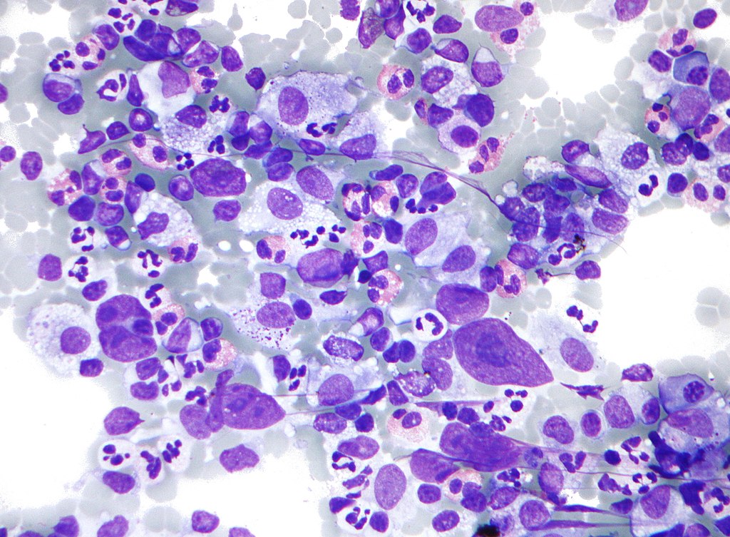 Imagen: Fotomicrografía de linfoma de Hodgkin (LH) de un aspirado con aguja fina de un ganglio linfático. La micrografía muestra una mezcla de células comunes en el LH: eosinófilos, células de Reed-Sternberg, células plasmáticas e histiocitos (Fotografía cortesía de Nephron).
