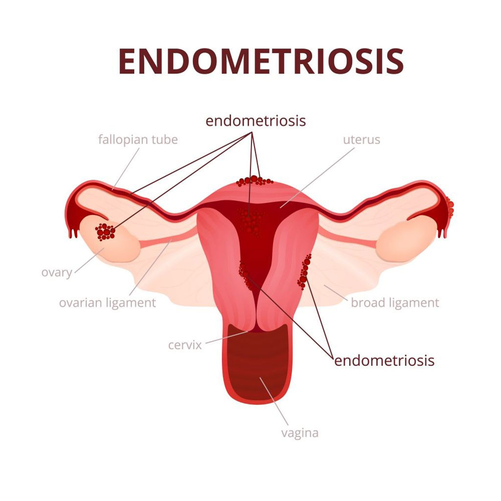 Imagen: Endometriosis: ilustración esquemática del útero y las enfermedades del sistema reproductivo femenino (Fotografía cortesía de www.123rf.com)