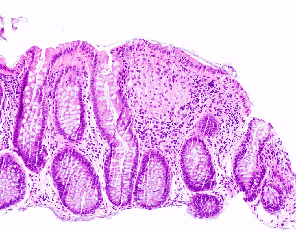 Imagen: Histopatología de un paciente con enfermedad de Crohn que muestra evidencia de un granuloma epitelioide no necrotizante (Fotografía cortesía de Catherine E. Hagen, MD y Luisa Ricaurte Archila, MD)