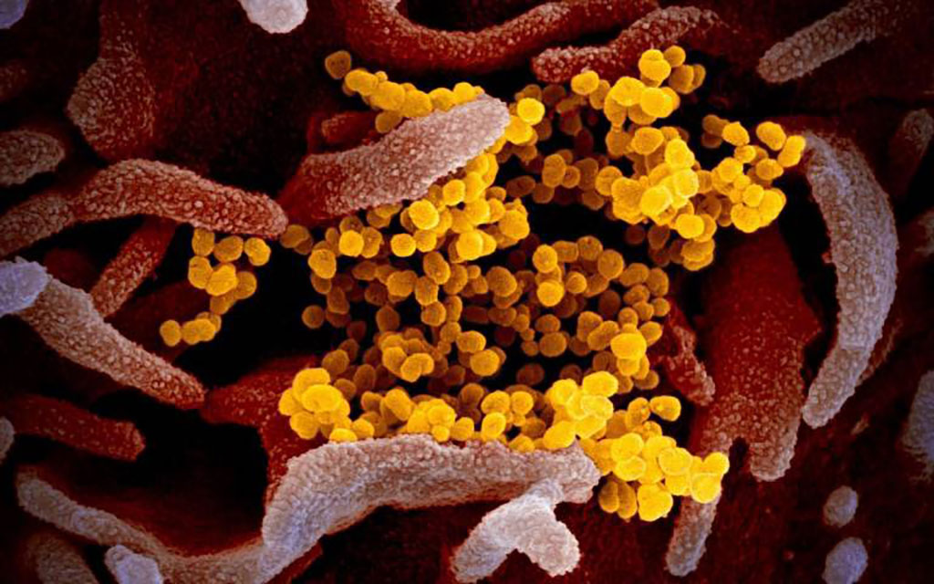 Imagen: La imagen del microscopio electrónico de barrido que muestra al SARS-CoV-2 (amarillo) (Fotografía cortesía de NIAID-RML)