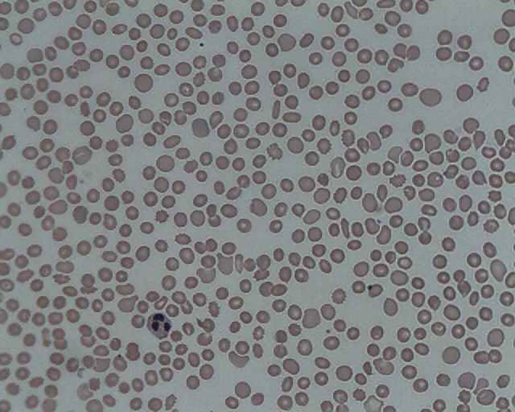 Imagen: Un frotis de sangre de un paciente con trombocitopenia que está casi desprovisto de plaquetas (Fotografía cortesía del profesor Erhabor Osaro, FIBMS, PhD)