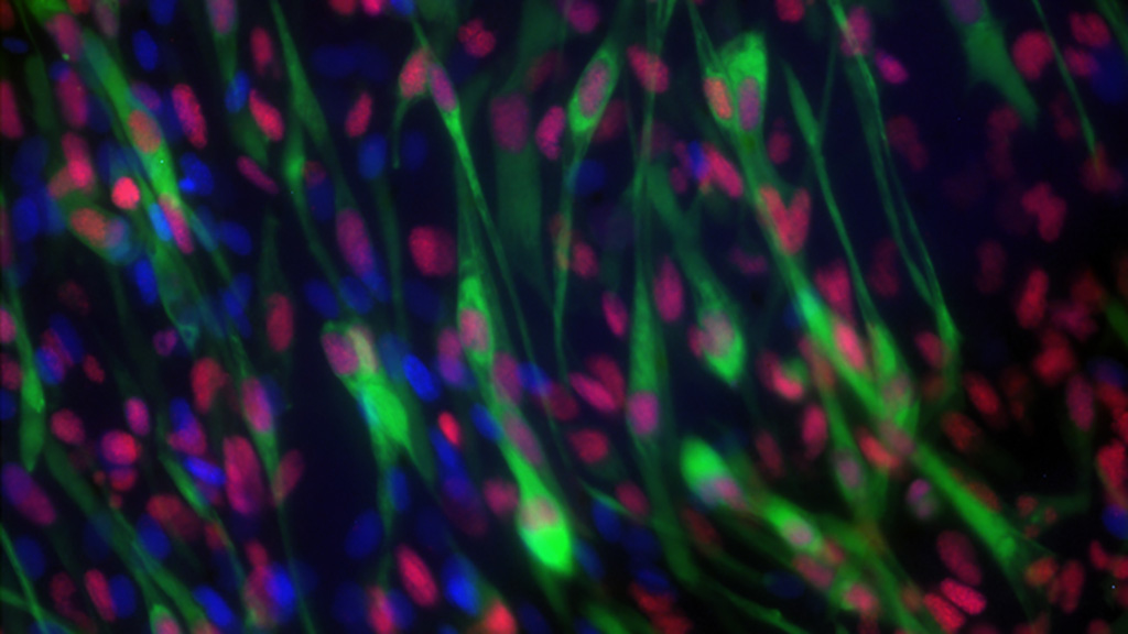 Imagen: Células de rabdomiosarcoma (Fotografía cortesía de ICR)
