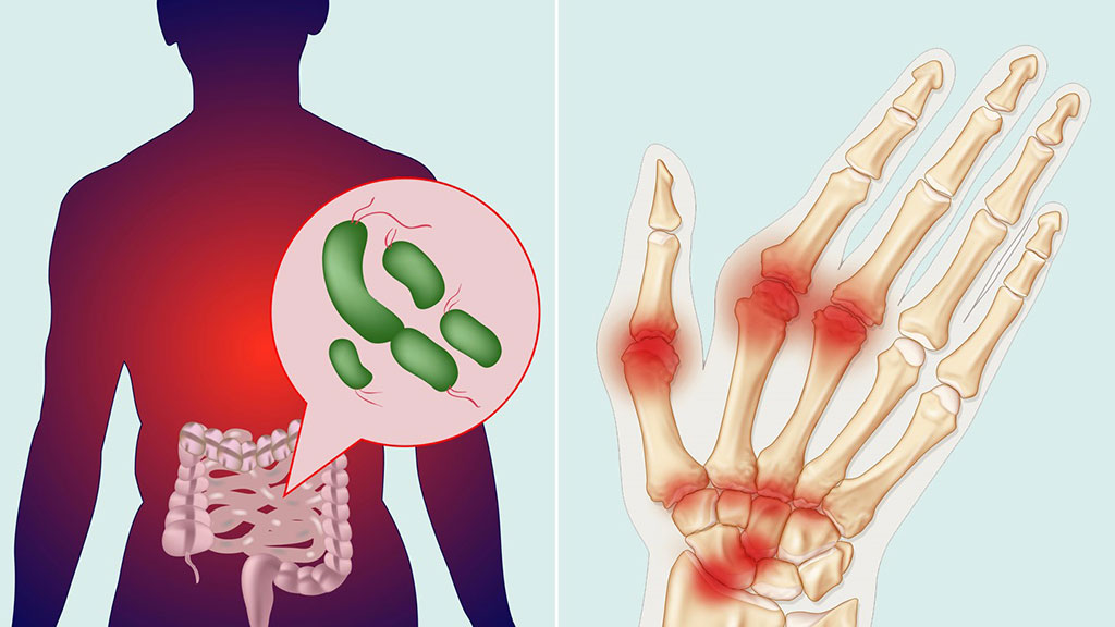 Imagen: La reacción inmunitaria a las bacterias intestinales puede desencadenar la artritis reumatoide (Fotografía cortesía de Everyday Health)