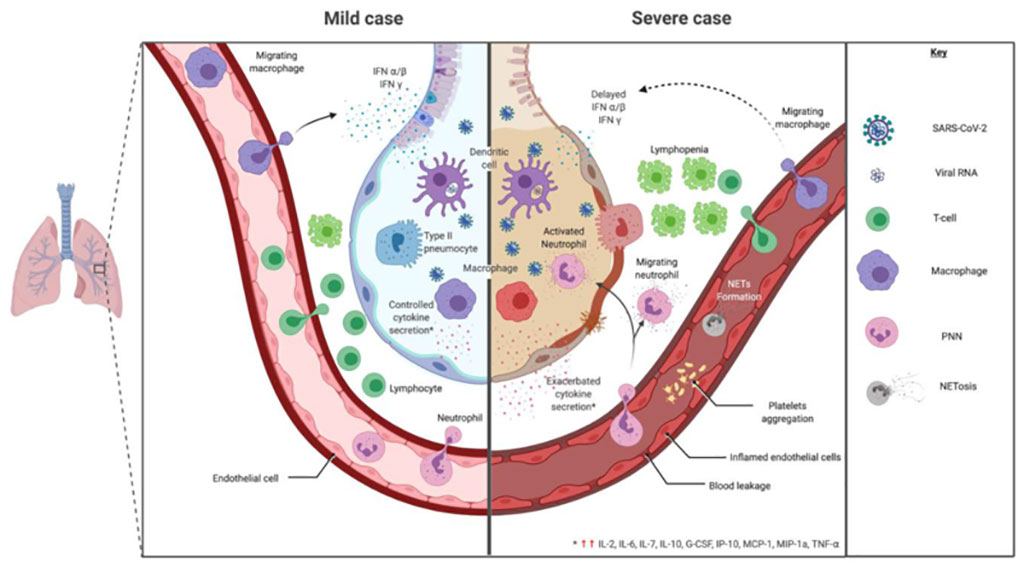 Imagen: Respuesta inmune leve versus severa durante la infección por COVID-19 (Fotografía cortesía de Wikimedia Commons)
