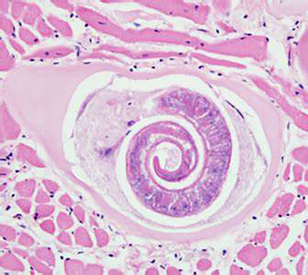 Imagen: Trichinella sp. encontrada en el tejido muscular (Fotografía cortesía de la Universidad McGill)