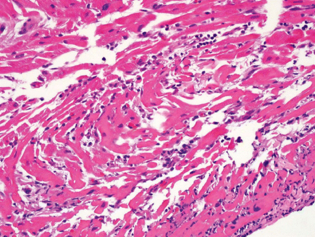 Imagen: Biopsia endomiocárdica que muestra miocarditis linfocítica (Fotografía cortesía de la Universidad de Marion)
