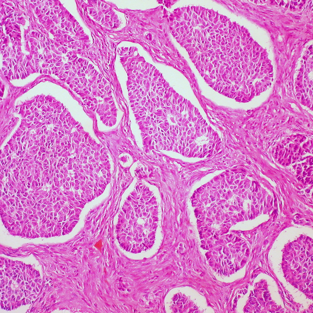 Imagen: Histopatología del tumor de células granulosas de ovario: el patrón microfolicular estaba presente focalmente (Fotografía cortesía del Dr. Edward Uthman MD)