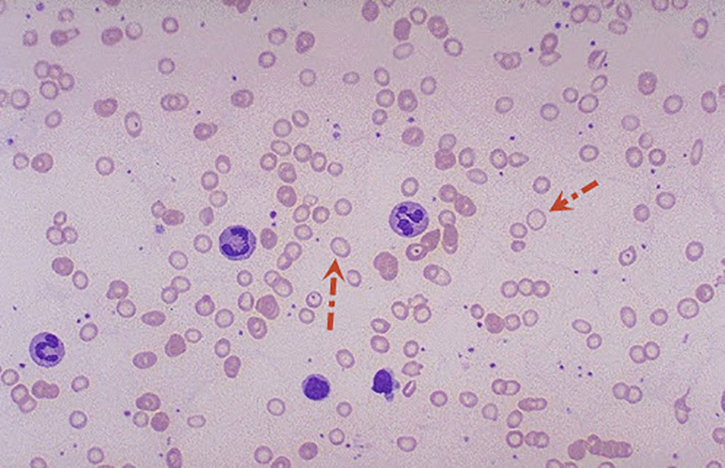 Imagen: Frotis de sangre que muestra eritrocitos hipocrómicos y microcíticos (glóbulos rojos) (Fotografía cortesía de Medical Laboratories)