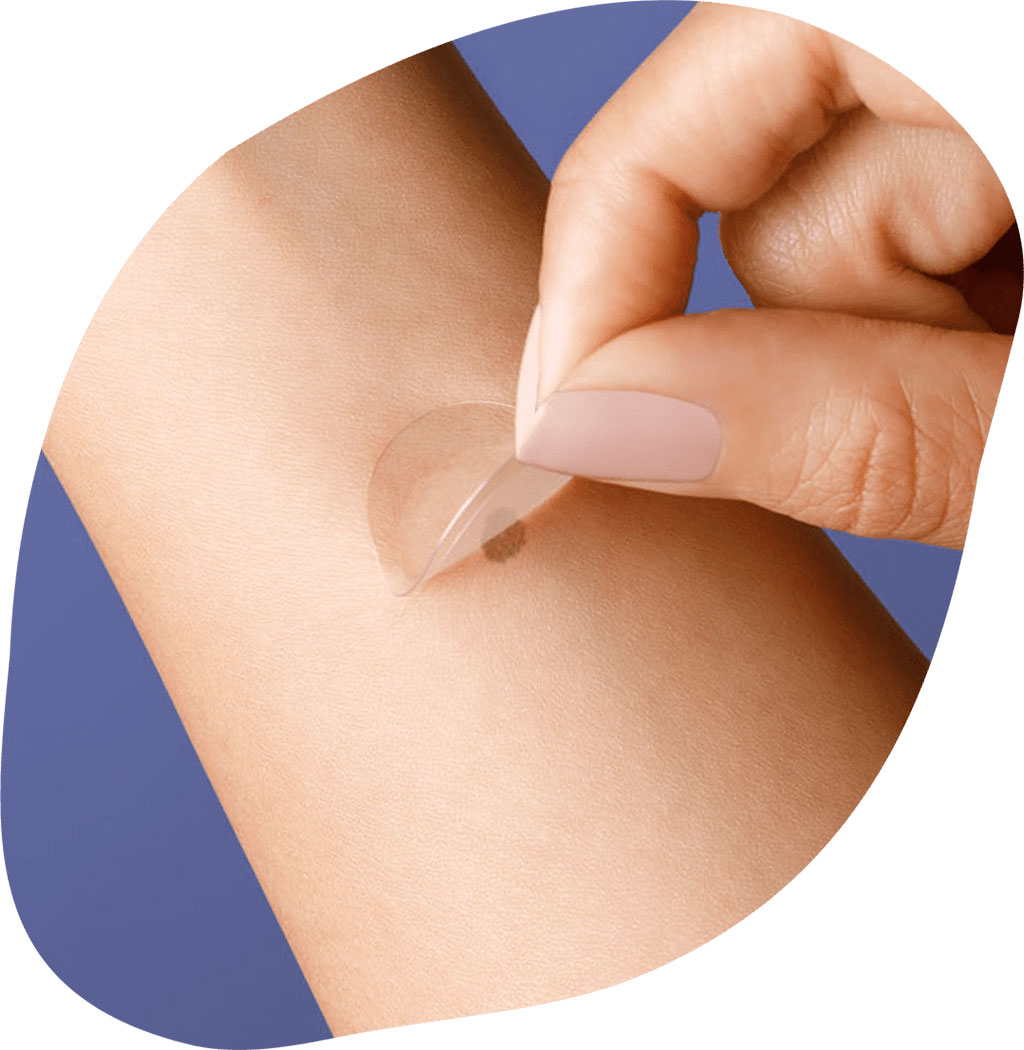 Imagen: Los adhesivos inteligentes están cambiando la forma en que se detecta el melanoma (Fotografía cortesía de DermTech)