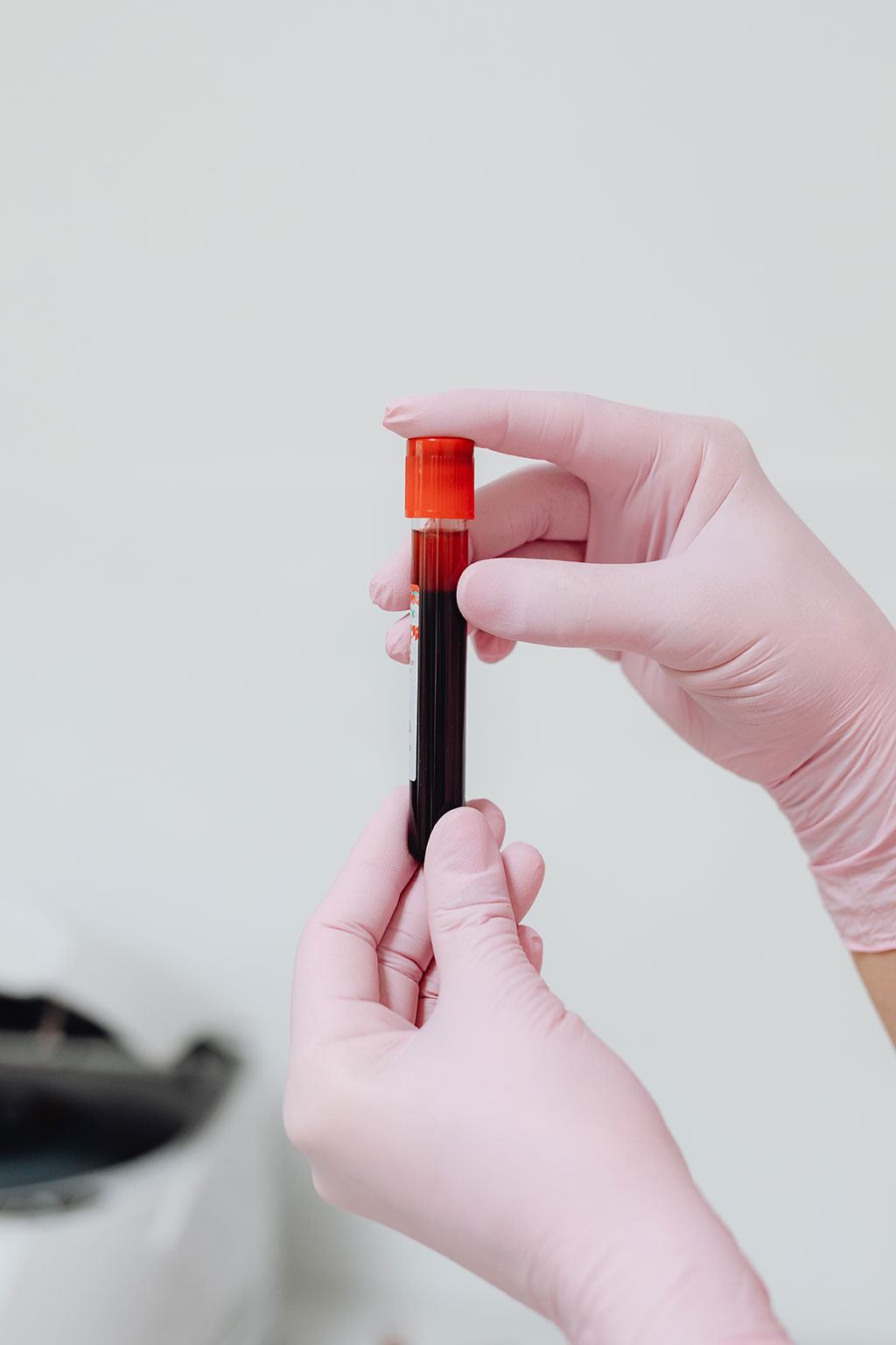 Imagen: El análisis de sangre para detectar el ADNtc podría ayudar a las personas con TEGI avanzado a elegir su tratamiento dirigido de segunda línea (Fotografía cortesía de Pexels)
