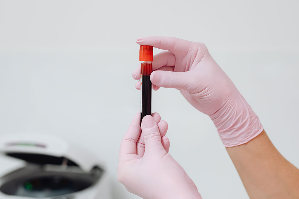 Imagen: Dímero D puede ayudar a hacer el diagnóstico difícil de la infección articular protésica (Fotografía cortesía de Pexels)