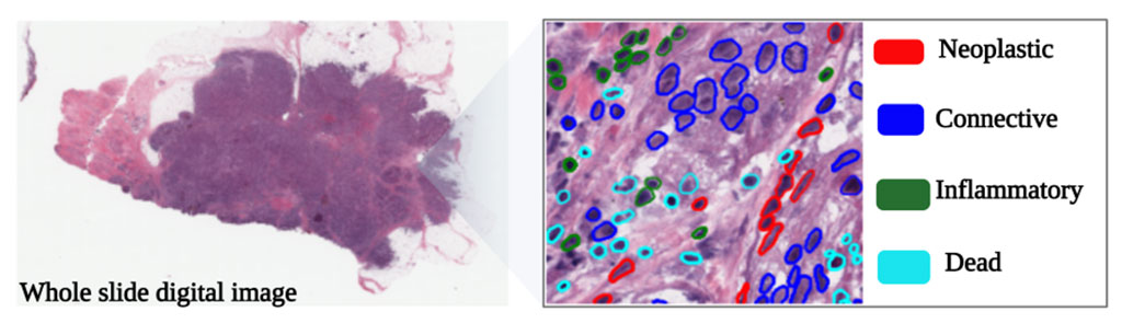 Imagen: Un marco de aprendizaje profundo que estima los tipos de células en una imagen de patología digital de diapositivas completa (Fotografía cortesía de la Universidad de Finlandia Oriental)