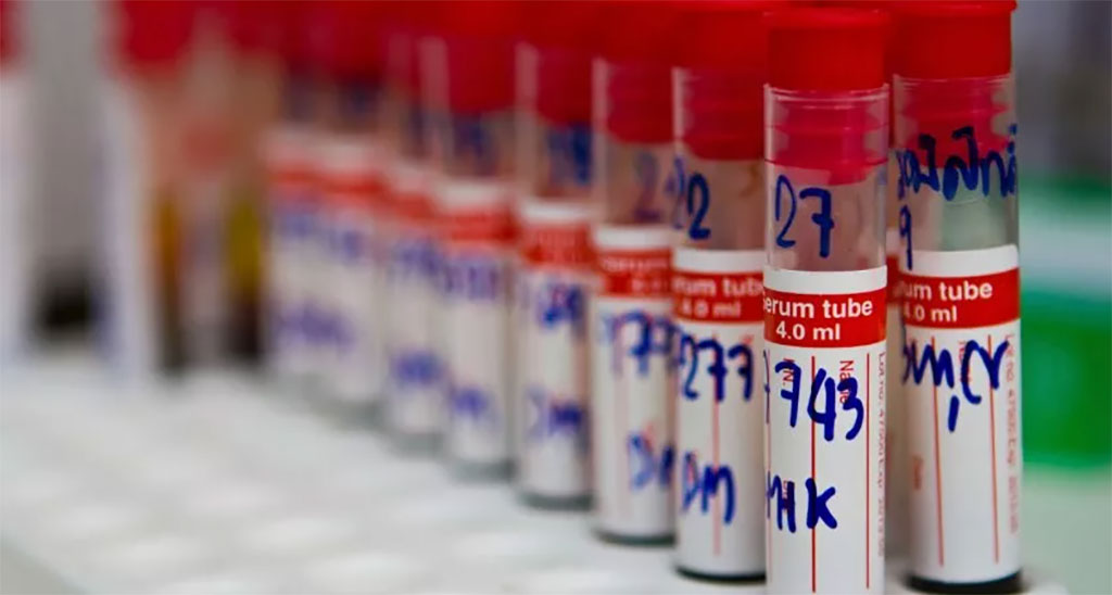 Imagen: Prueba LucentAD evalúa la probabilidad de que un paciente tenga patología amiloide consistente con la enfermedad de Alzheimer (Fotografía cortesía de Freepik)