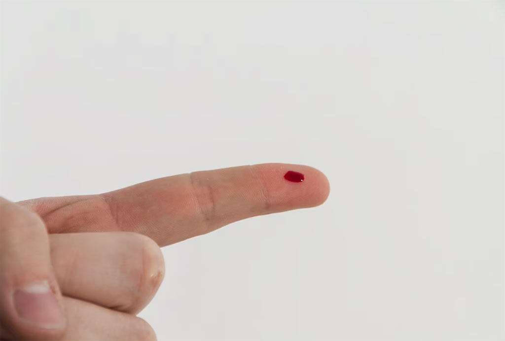 Imagen: Simple prueba de pinchazo de dedo ejemplifica los avances en los análisis de sangre de la enfermedad de Alzheimer (Fotografía cortesía de Freepik)