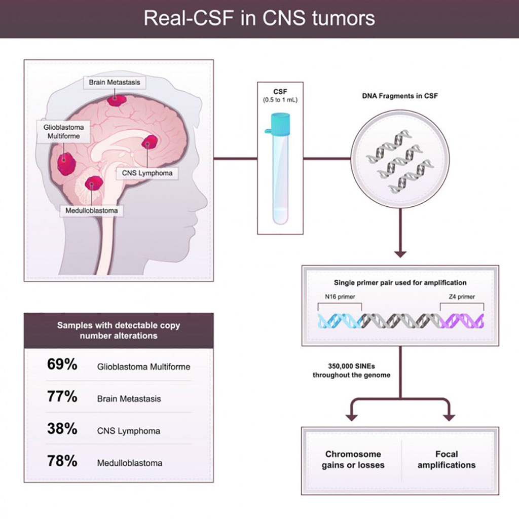 Imagen: La prueba Real-CSF mide el material genético anormal que circula en el líquido cefalorraquídeo (Fotografía cortesía de Johns Hopkins)