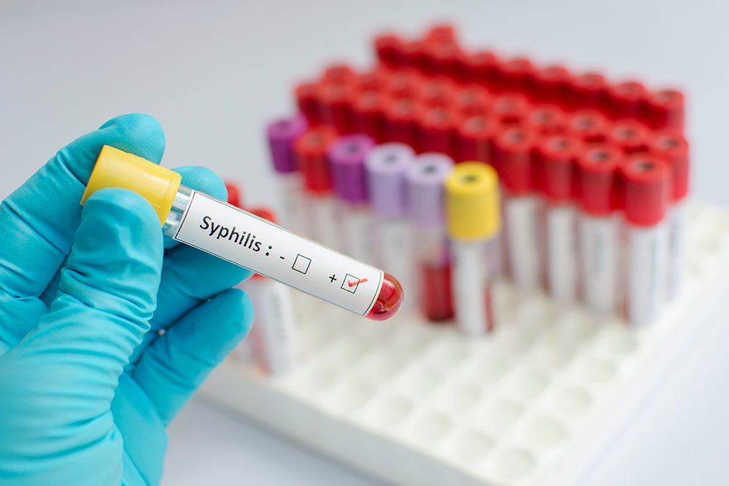 Imagen: Existen pocas pruebas de diagnóstico sensibles para determinar si un bebé ha desarrollado sífilis congénita (Fotografía cortesía de 123RF)