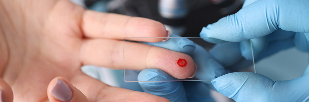 Imagen: Dos análisis de sangre de marcadores séricos ampliamente disponibles mejoran la sensibilidad diagnóstica de las infecciones fúngicas invasivas (Fotografía cortesía de 123RF)