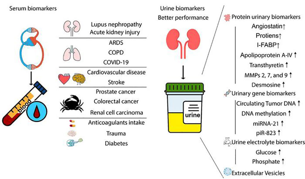 Imagen: Los biomarcadores de orina pueden superar a los biomarcadores séricos en ciertas enfermedades (Fotografía cortesía de Xue C, et al.)